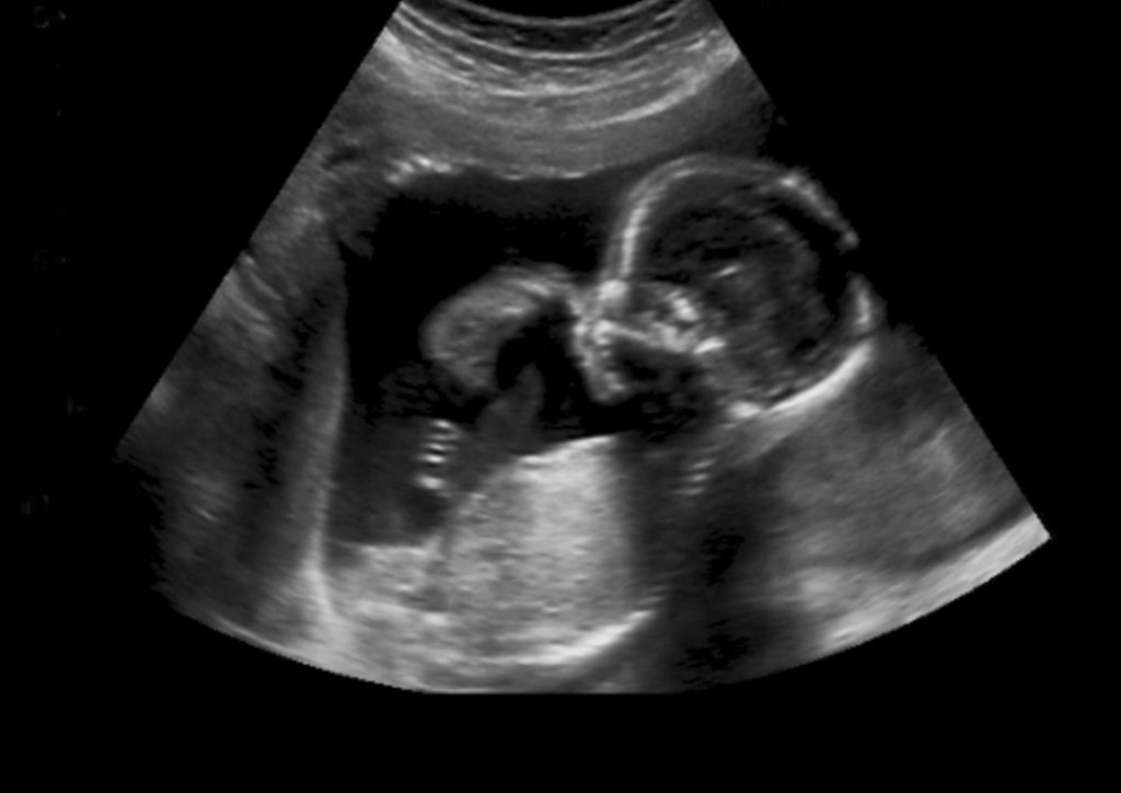 Third trimester fetal ultrasound